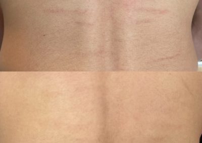 Scracthes on back