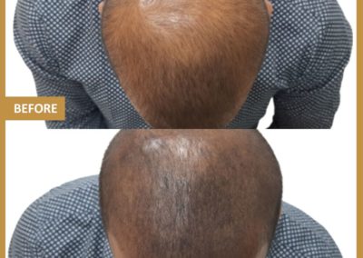 Bald head of man